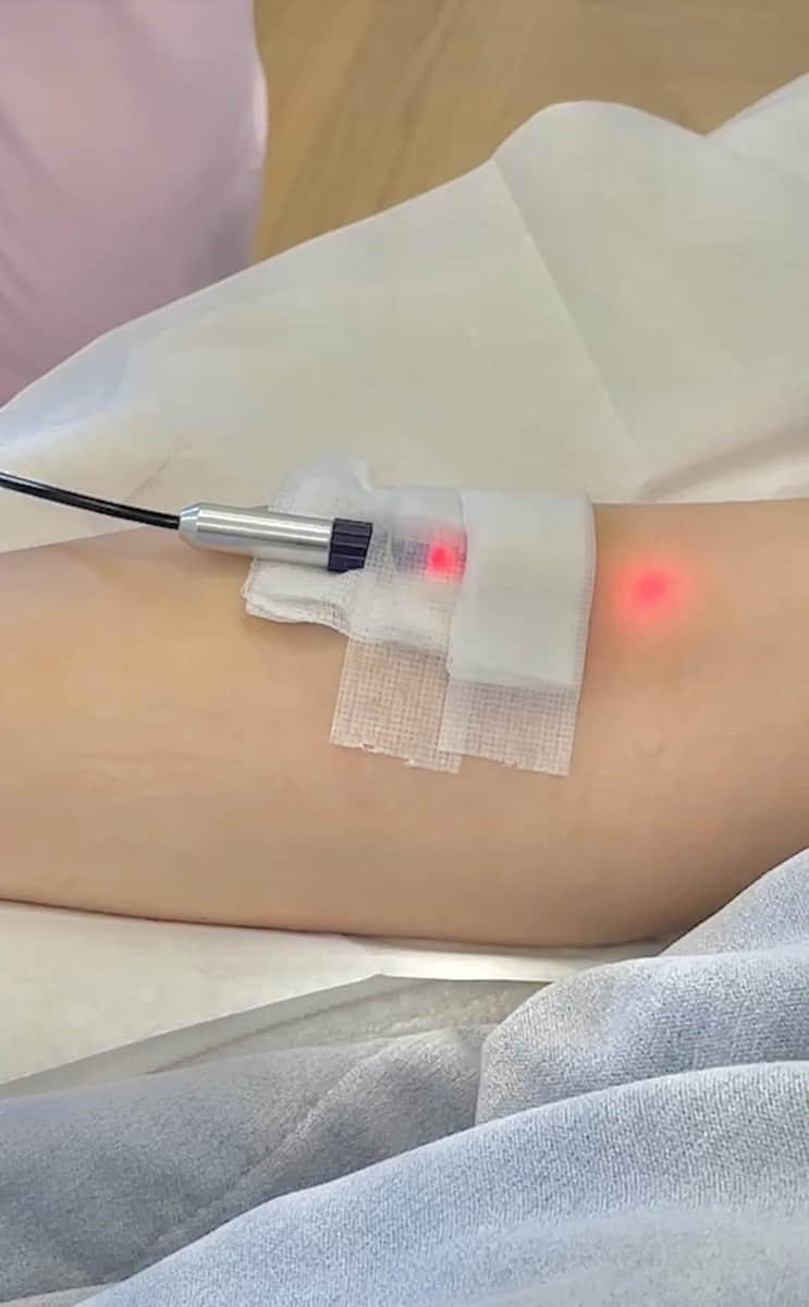 2025靜脈雷射全指南！靜脈雷射原理、治療流程、功效、適用症狀1次掌握